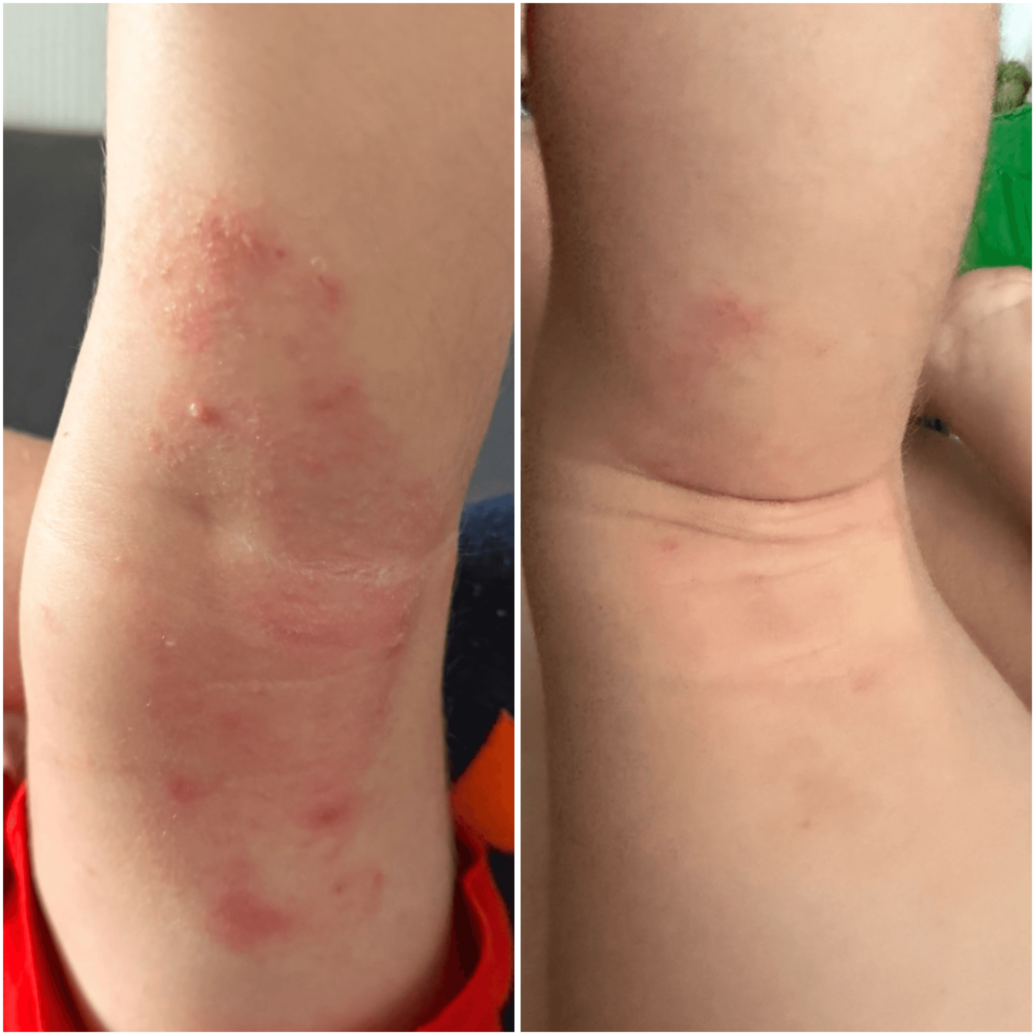 CBD-Creme für trockene, atopische und zu Ekzemen neigende Haut