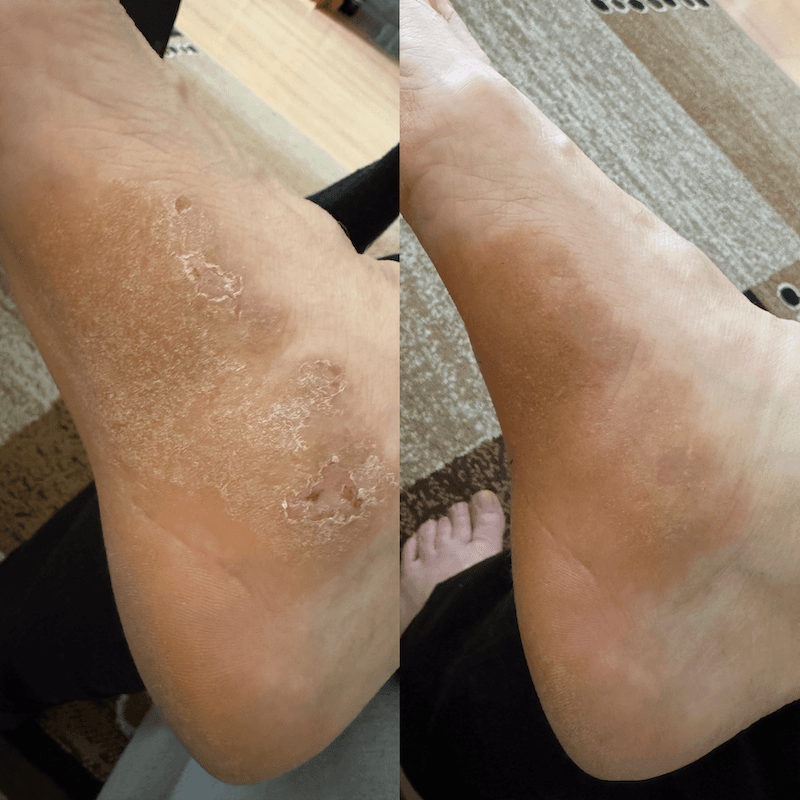 CBD-Creme für trockene, atopische und zu Ekzemen neigende Haut