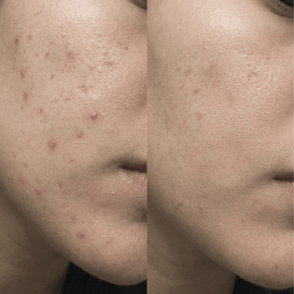 Blemish Purity CBD-Creme für unreine Haut