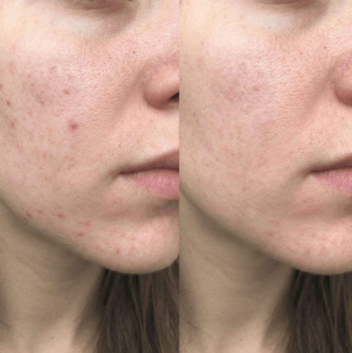 Blemish Purity CBD-Creme für unreine Haut