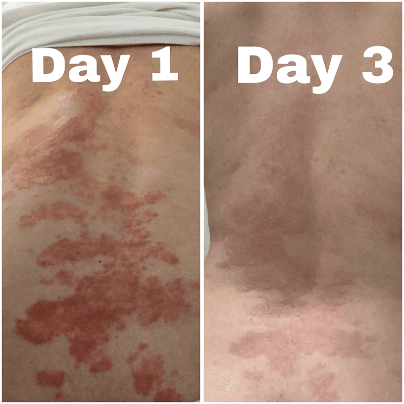 CBD-Creme für trockene, atopische und zu Ekzemen neigende Haut