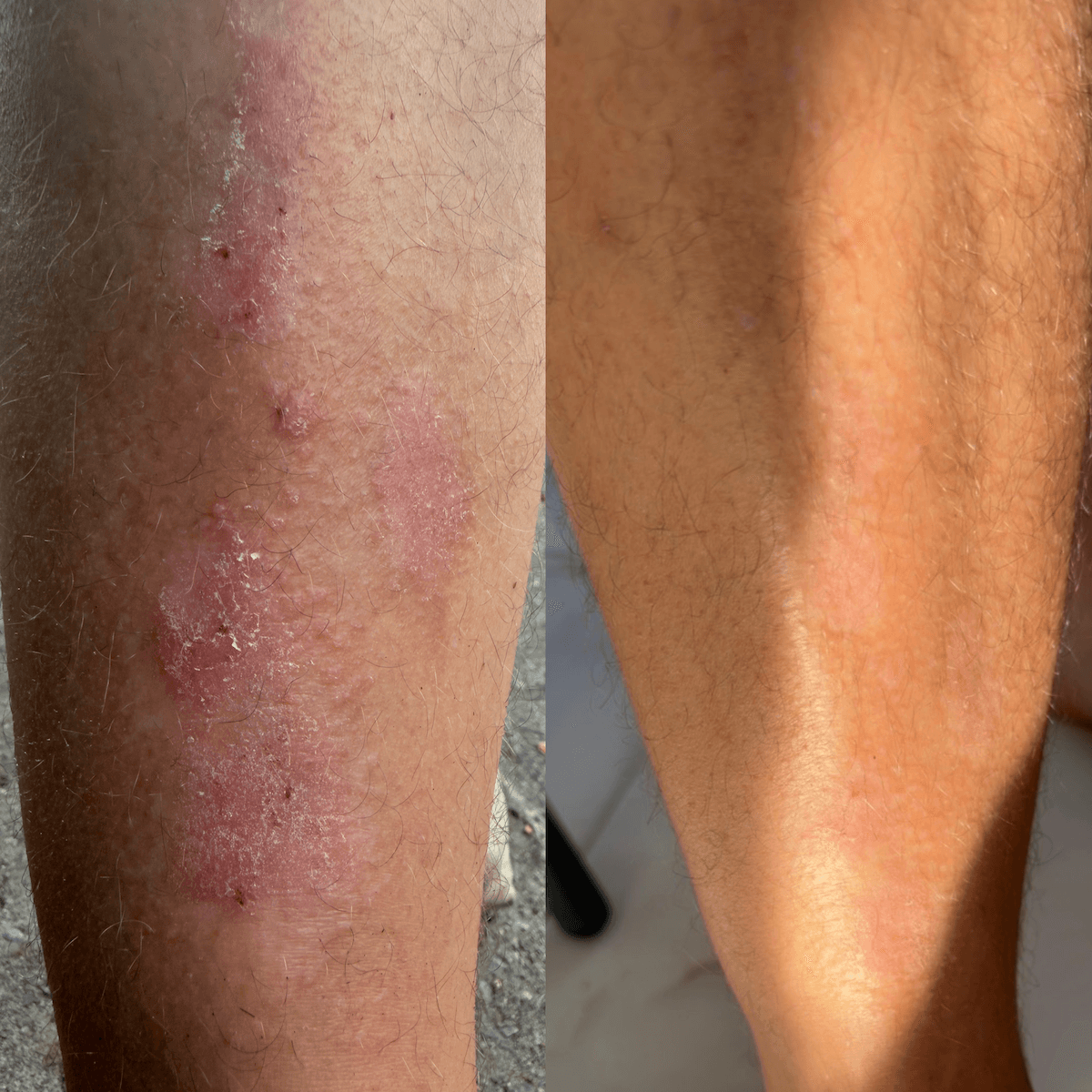 Restorative CBD-Creme für trockene, schuppige und zu Schuppenflechte neigende Haut